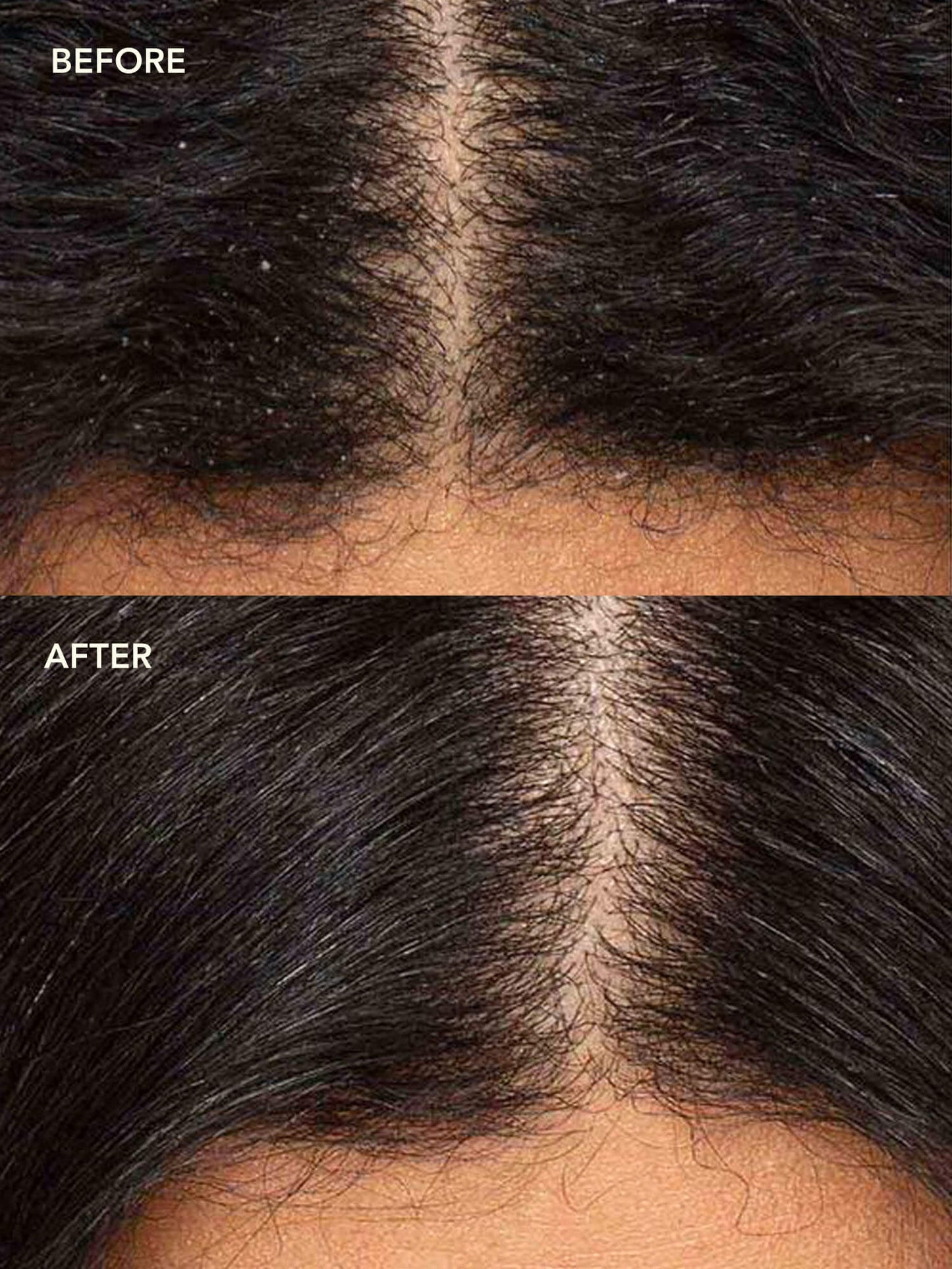 NEEM + SALICYLIC ACID Exfoliating Scalp Serum